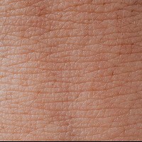 Dermatitis y eczemas